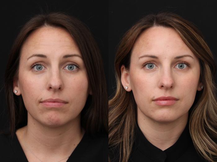Before & After Botox Case 420 Front View in Santa Rosa, California