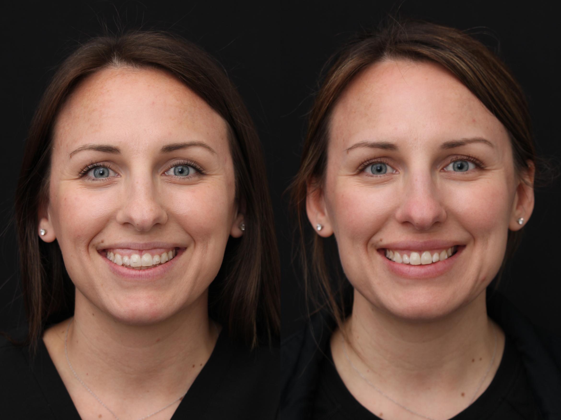 Before & After Botox Case 420 View 2 View in Santa Rosa, California