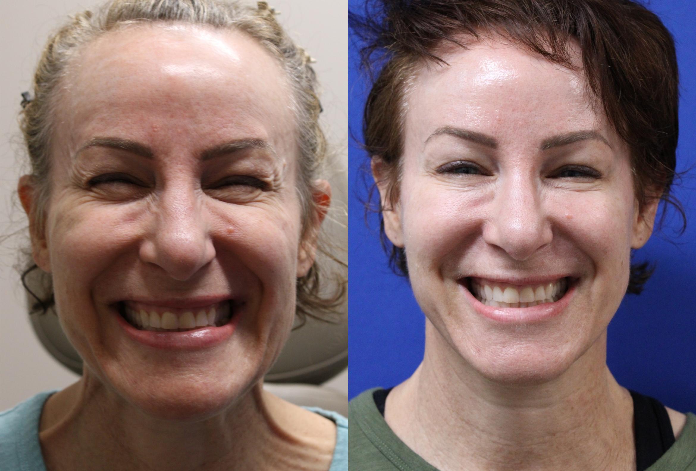 Before & After Botox Case 432 Front Platysma Bands View in Santa Rosa, California