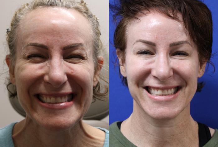 Before & After Botox Case 432 Front Platysma Bands View in Santa Rosa, California