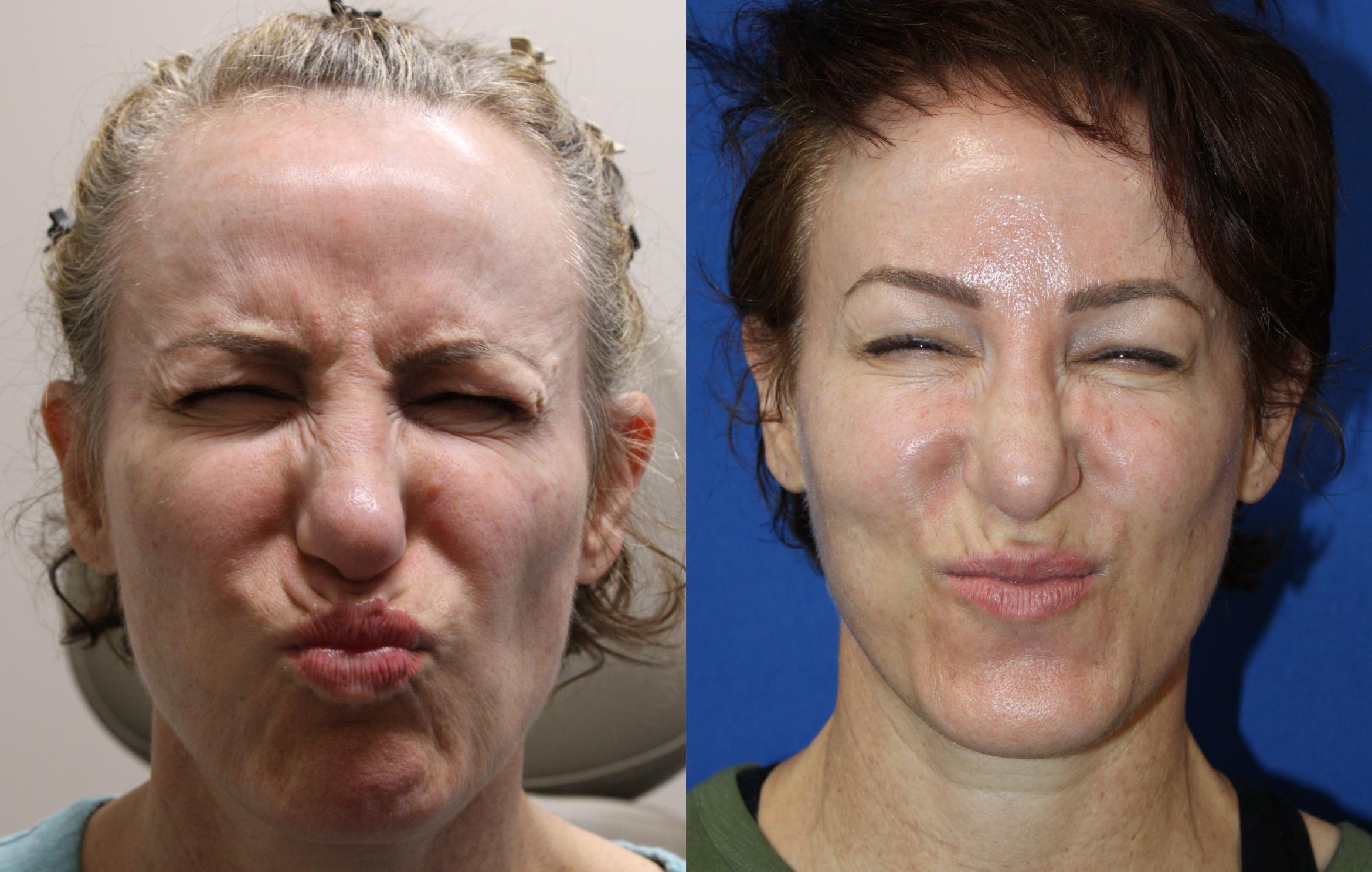 Before & After Botox Case 432 Front View View in Santa Rosa, California