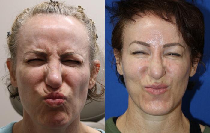 Before & After Botox Case 432 Front View View in Santa Rosa, California