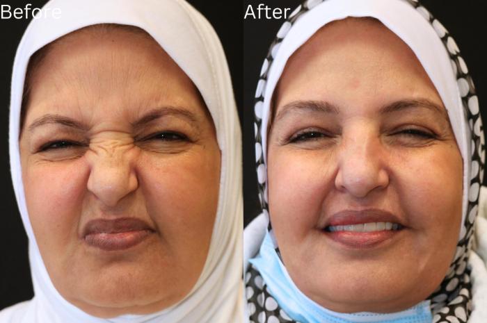 Before & After Botox Case 57 View 1 View in Santa Rosa, California