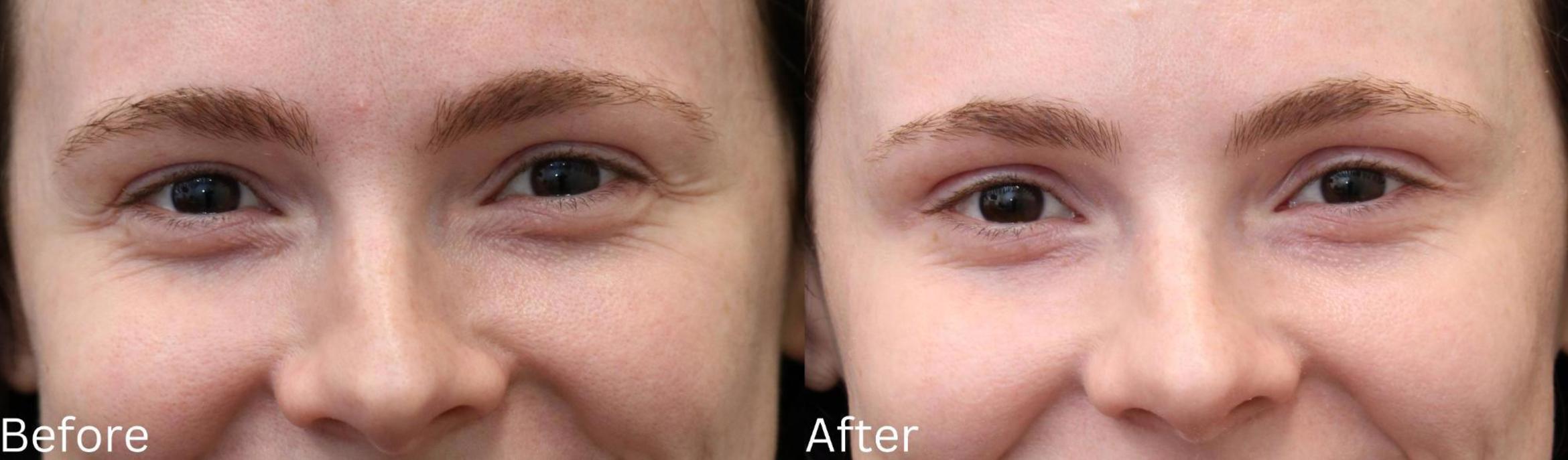 Before & After Botox Case 58 View 1 View in Santa Rosa, California
