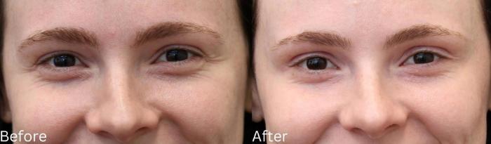 Before & After Botox Case 58 View 1 View in Santa Rosa, California