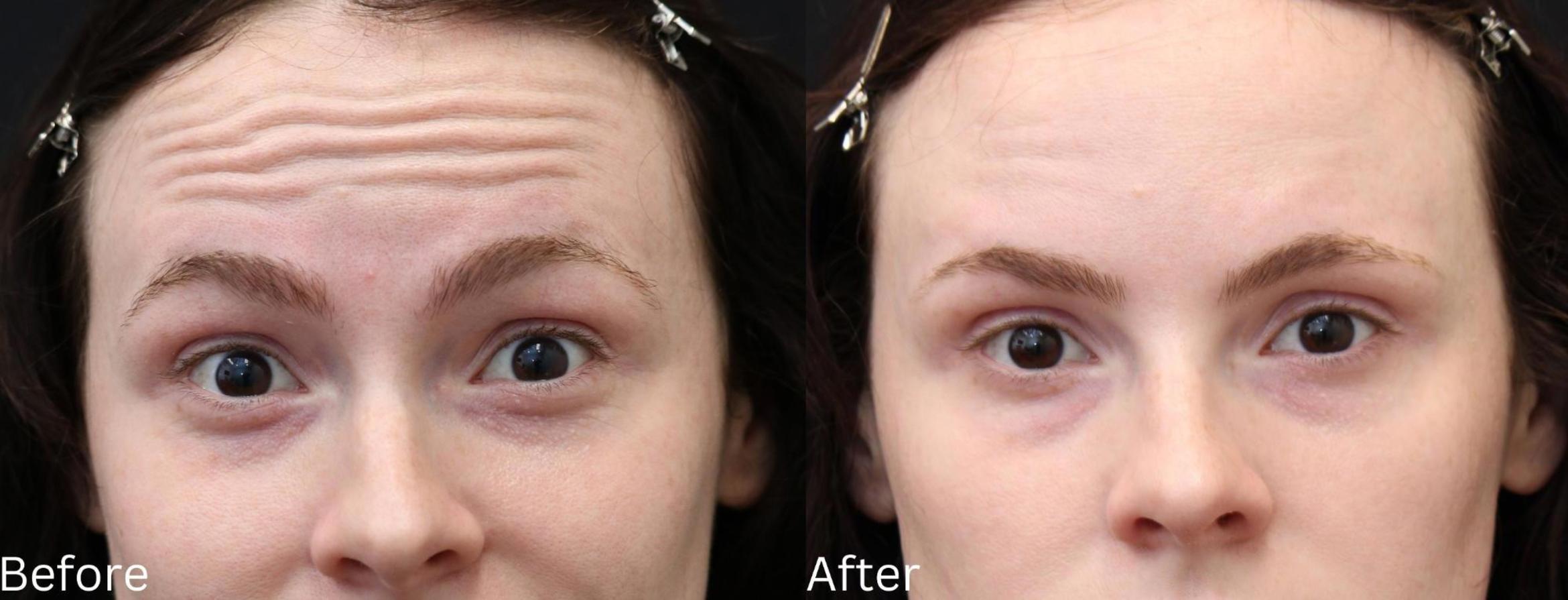 Before & After Botox Case 58 View 2 View in Santa Rosa, California