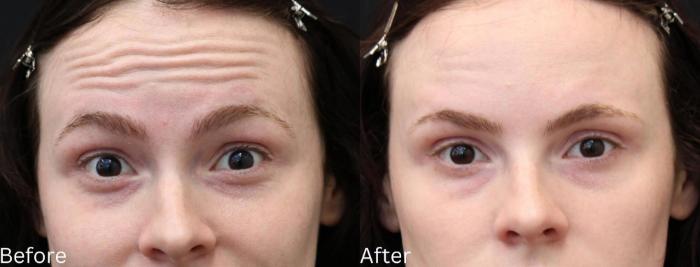 Before & After Botox Case 58 View 2 View in Santa Rosa, California