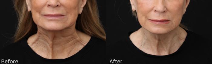 Before & After Botox Case 59 View 1 View in Santa Rosa, California