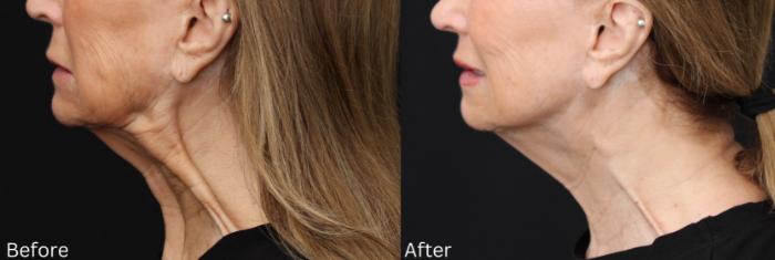 Before & After Botox Case 59 View 2 View in Santa Rosa, California