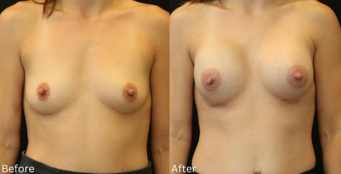 Before & After Breast Augmentation Case 100 View 1 View in Santa Rosa, California