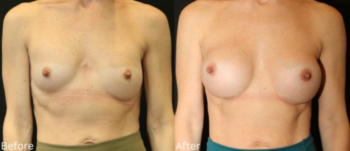 Before & After Breast Augmentation Case 101 View 1 View in Santa Rosa, California