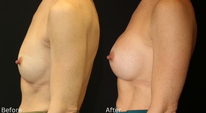 Before & After Breast Augmentation Case 101 View 2 View in Santa Rosa, California