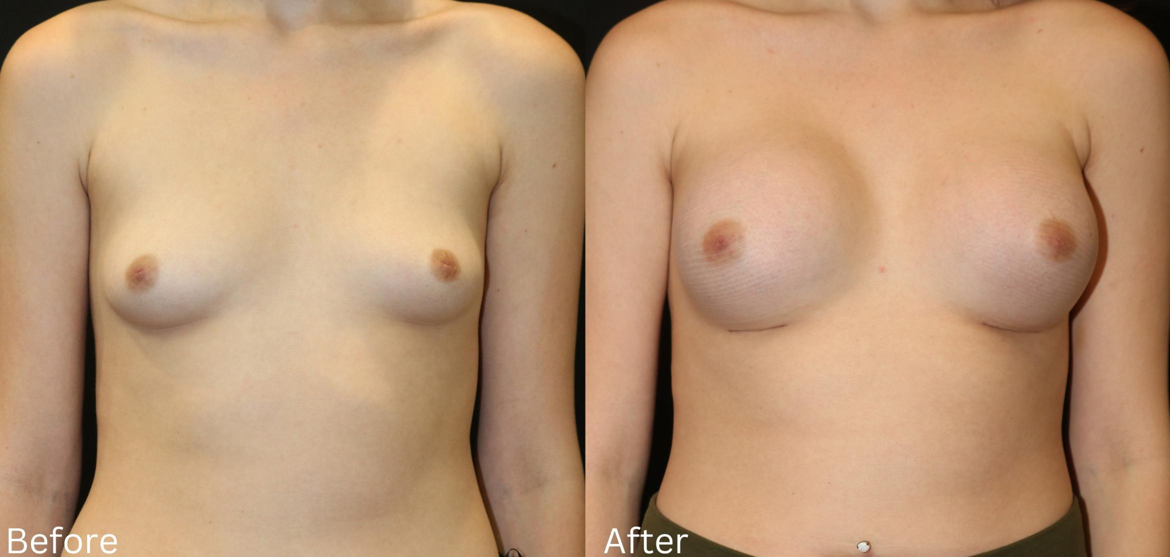 Before & After Breast Augmentation Case 102 View 1 View in Santa Rosa, California