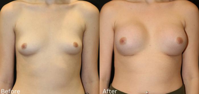 Before & After Breast Augmentation Case 102 View 1 View in Santa Rosa, California