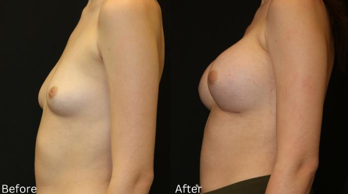 Before & After Breast Augmentation Case 102 View 2 View in Santa Rosa, California