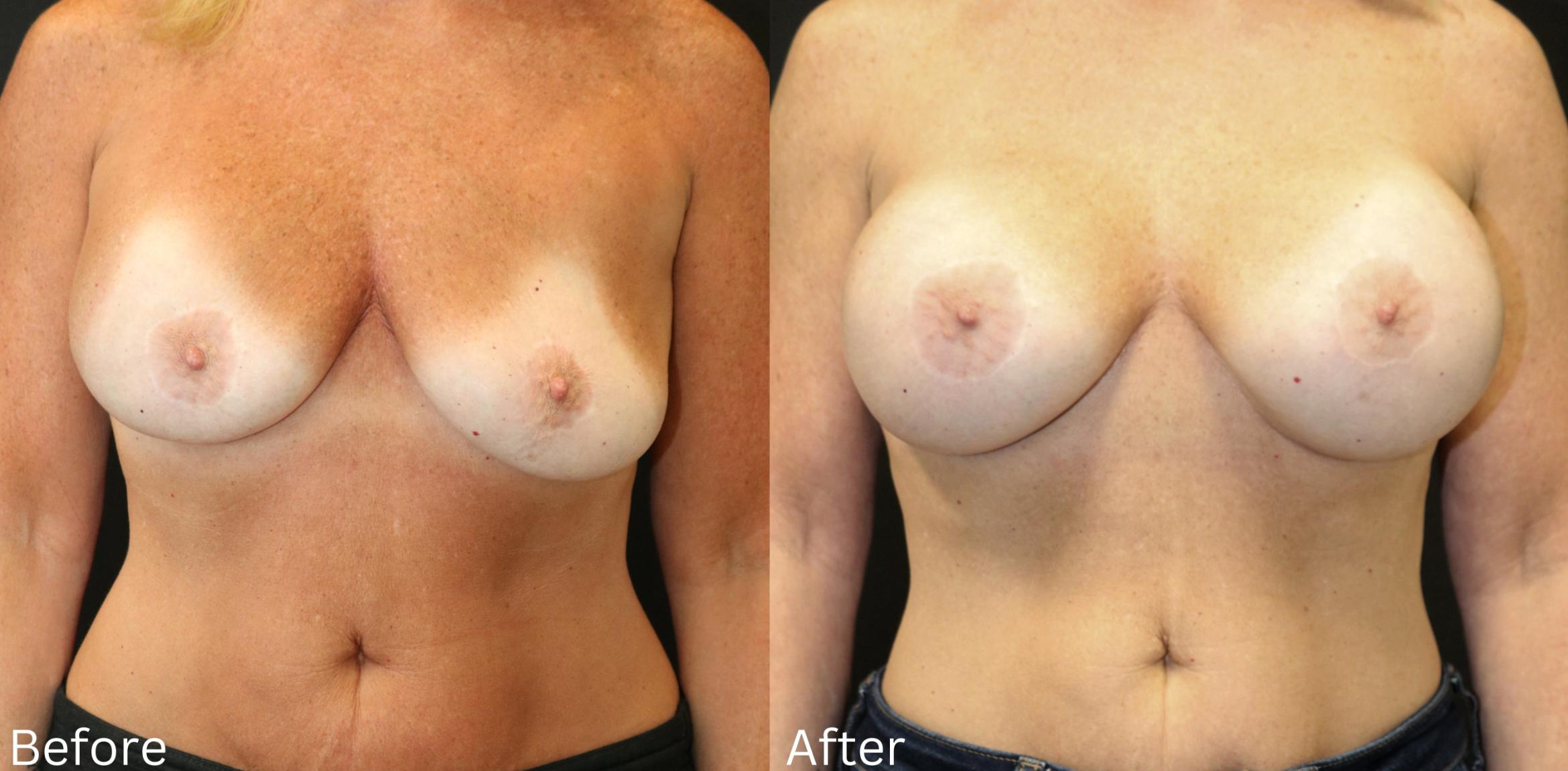 Before & After Breast Augmentation Case 103 View 1 View in Santa Rosa, California