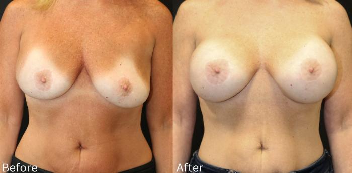 Before & After Breast Augmentation Case 103 View 1 View in Santa Rosa, California