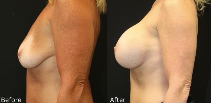 Before & After Breast Augmentation Case 103 View 2 View in Santa Rosa, California