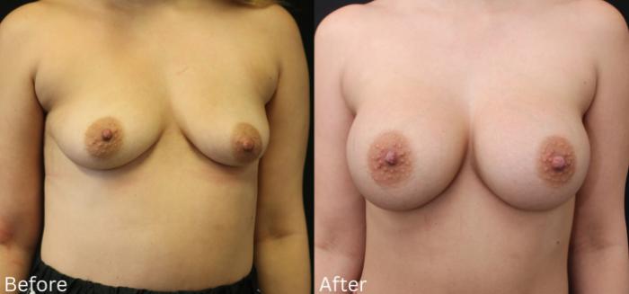 Before & After Breast Augmentation Case 104 View 1 View in Santa Rosa, California