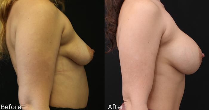 Before & After Breast Augmentation Case 104 View 2 View in Santa Rosa, California