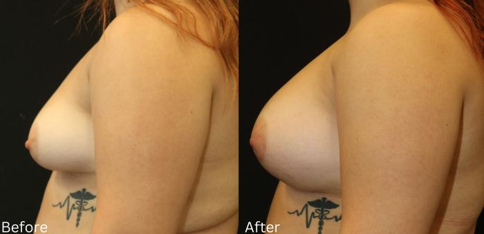 Before & After Breast Augmentation Case 105 View 2 View in Santa Rosa, California