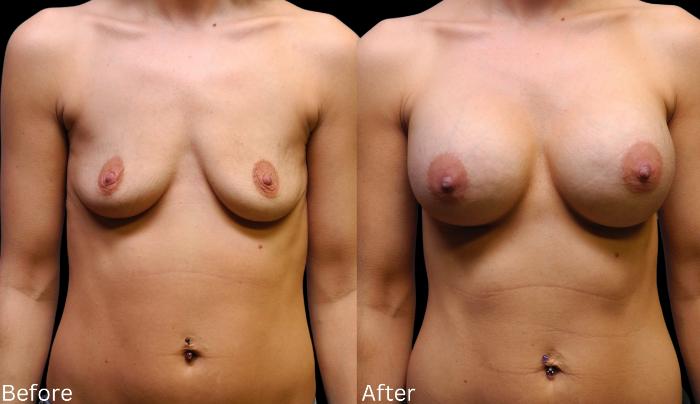 Before & After Breast Augmentation Case 106 View 1 View in Santa Rosa, California