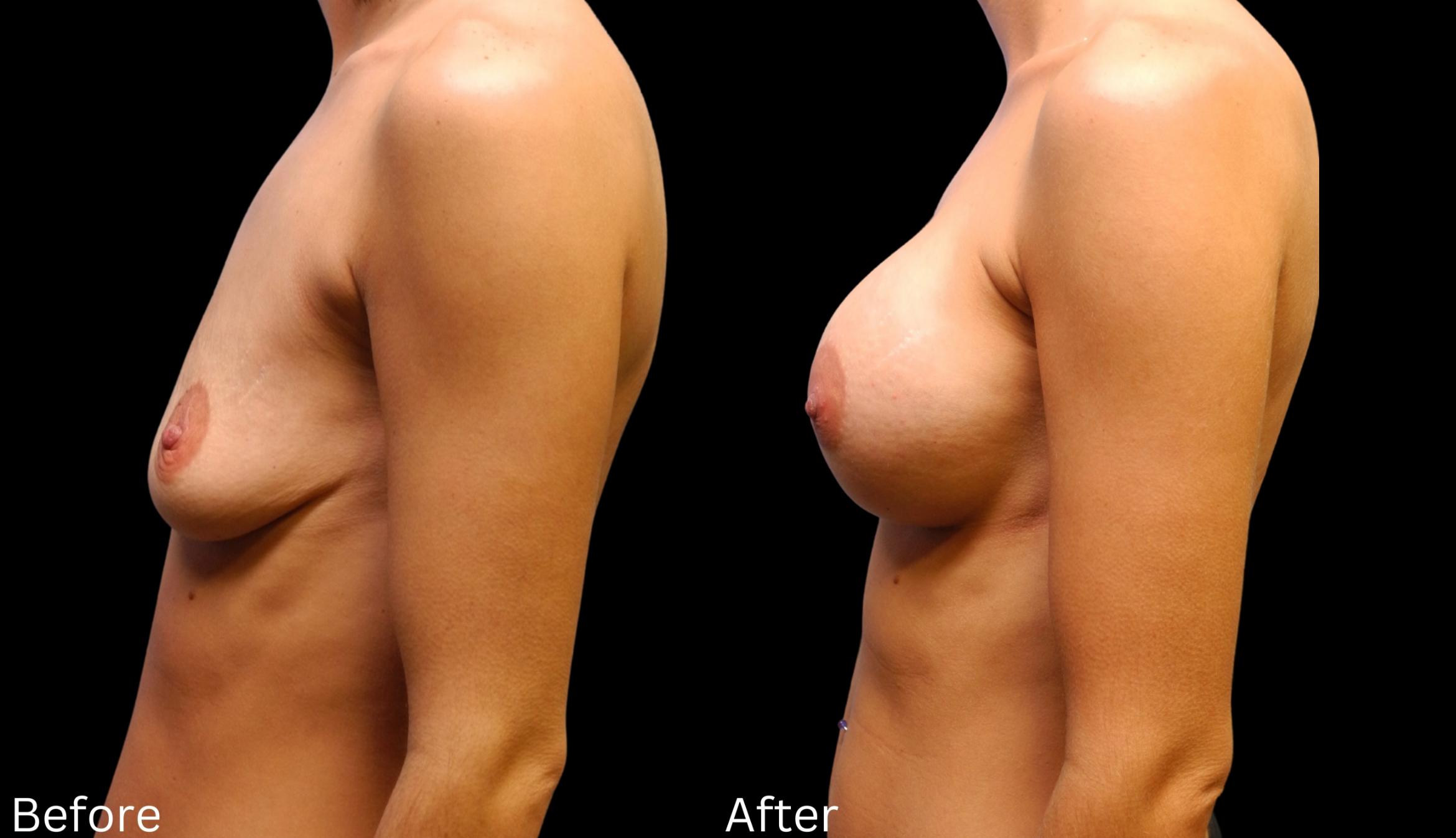 Before & After Breast Augmentation Case 106 View 2 View in Santa Rosa, California