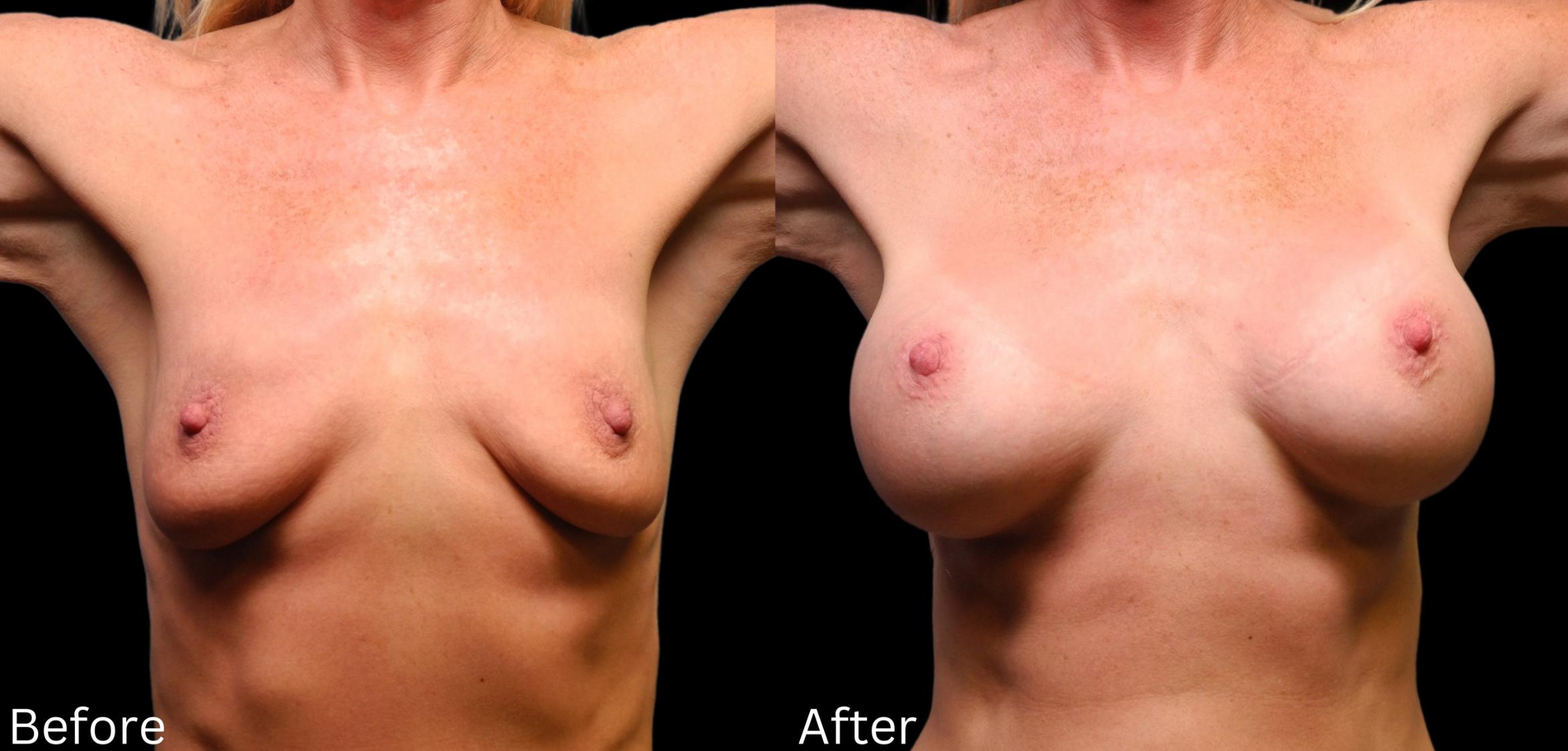 Before & After Breast Augmentation Case 107 View 1 View in Santa Rosa, California