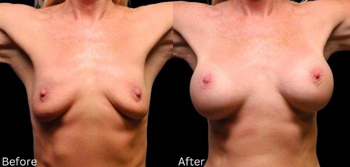 Before & After Breast Augmentation Case 107 View 1 View in Santa Rosa, California