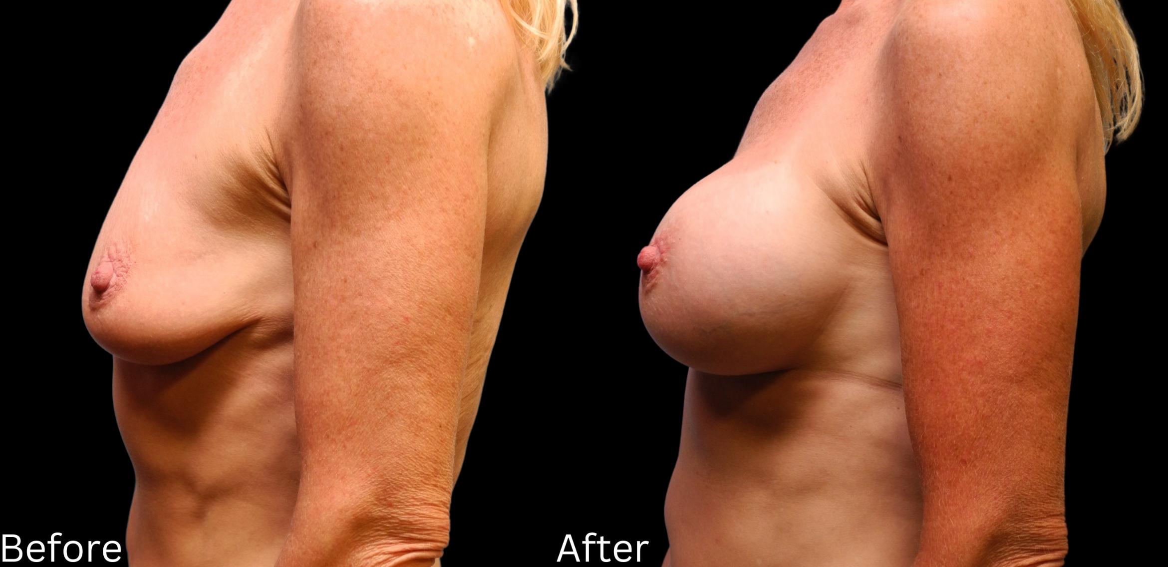 Before & After Breast Augmentation Case 107 View 2 View in Santa Rosa, California