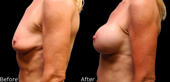 Before & After Breast Augmentation Case 107 View 2 View in Santa Rosa, California