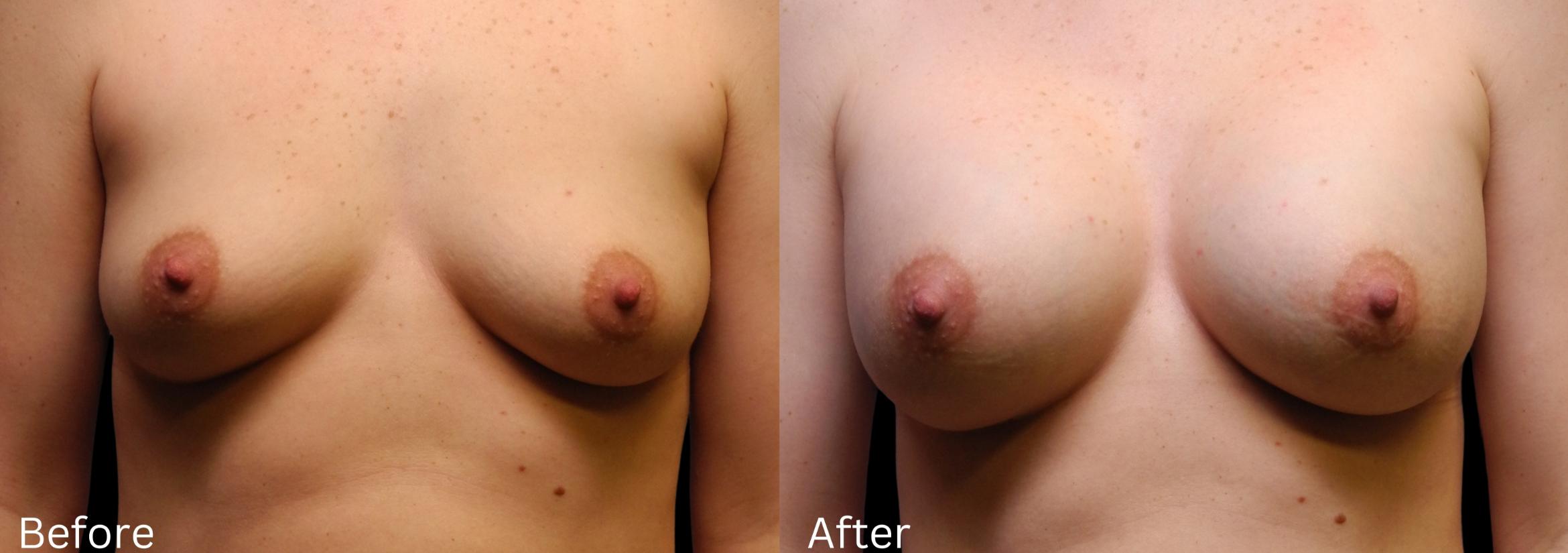 Before & After Breast Augmentation Case 108 View 1 View in Santa Rosa, California