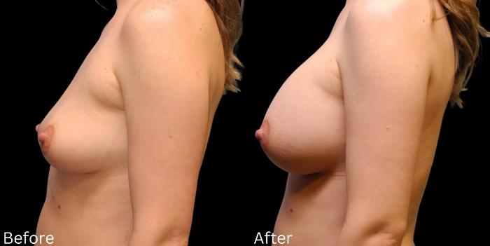 Before & After Breast Augmentation Case 108 View 2 View in Santa Rosa, California