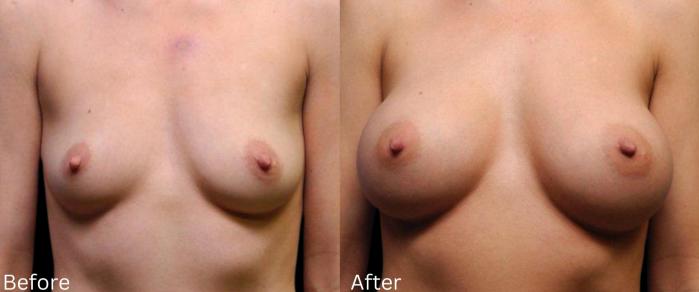 Before & After Breast Augmentation Case 109 View 1 View in Santa Rosa, California