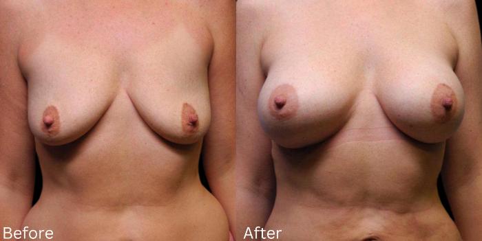 Before & After Breast Augmentation Case 110 View 1 View in Santa Rosa, California