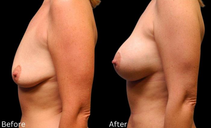 Before & After Breast Augmentation Case 110 View 2 View in Santa Rosa, California