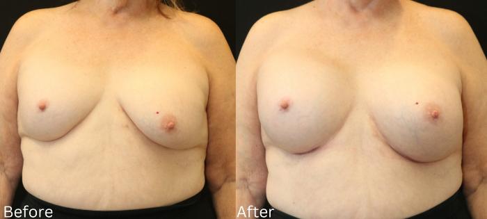 Before & After Breast Augmentation Case 111 View 1 View in Santa Rosa, California