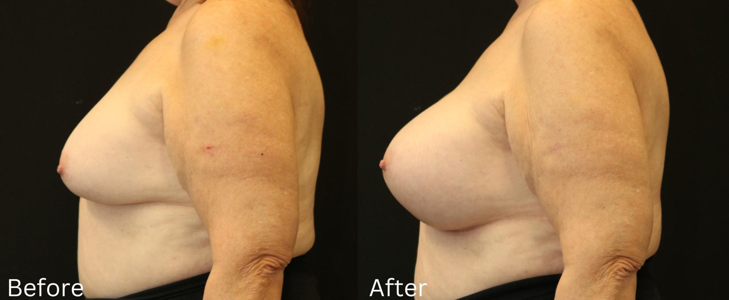 Before & After Breast Augmentation Case 111 View 2 View in Santa Rosa, California