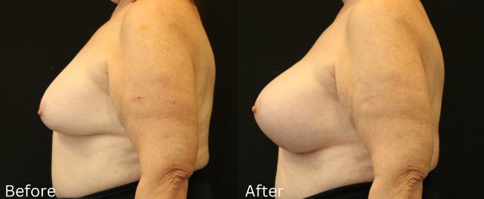Before & After Breast Augmentation Case 111 View 2 View in Santa Rosa, California