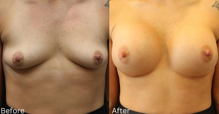 Before & After Breast Augmentation Case 112 View 1 View in Santa Rosa, California