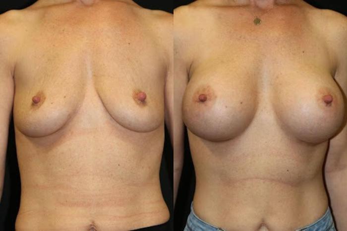 Before & After Breast Augmentation Case 286 View 1 View in Santa Rosa, California