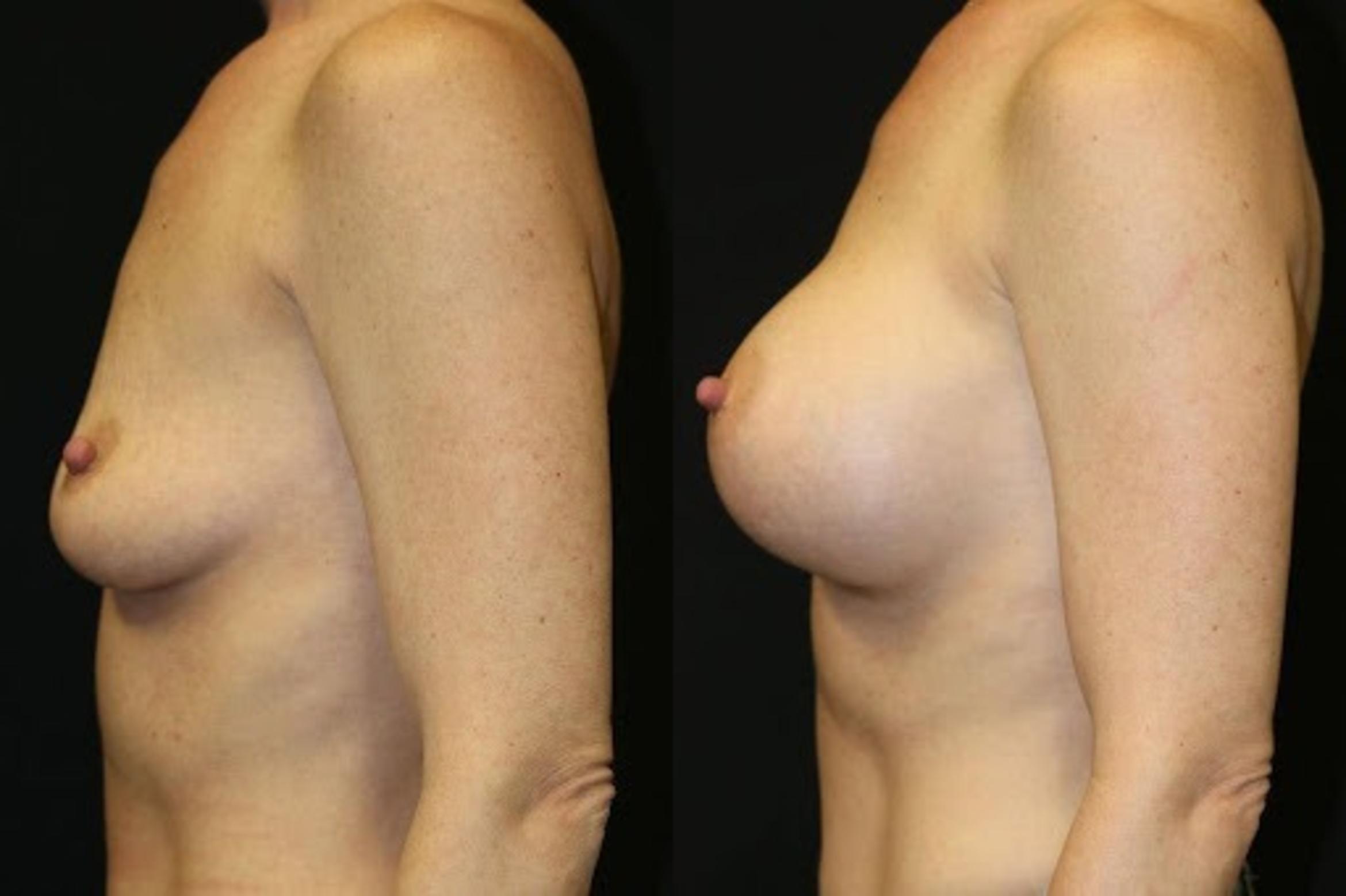 Before & After Breast Augmentation Case 286 View 2 View in Santa Rosa, California
