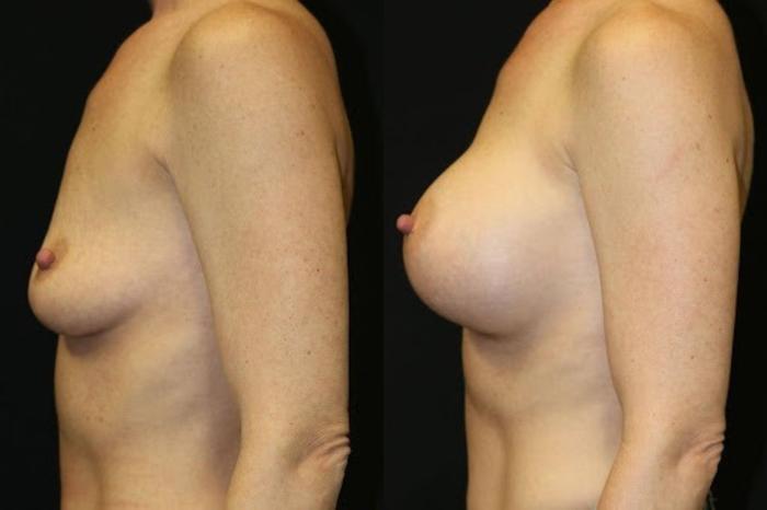 Before & After Breast Augmentation Case 286 View 2 View in Santa Rosa, California