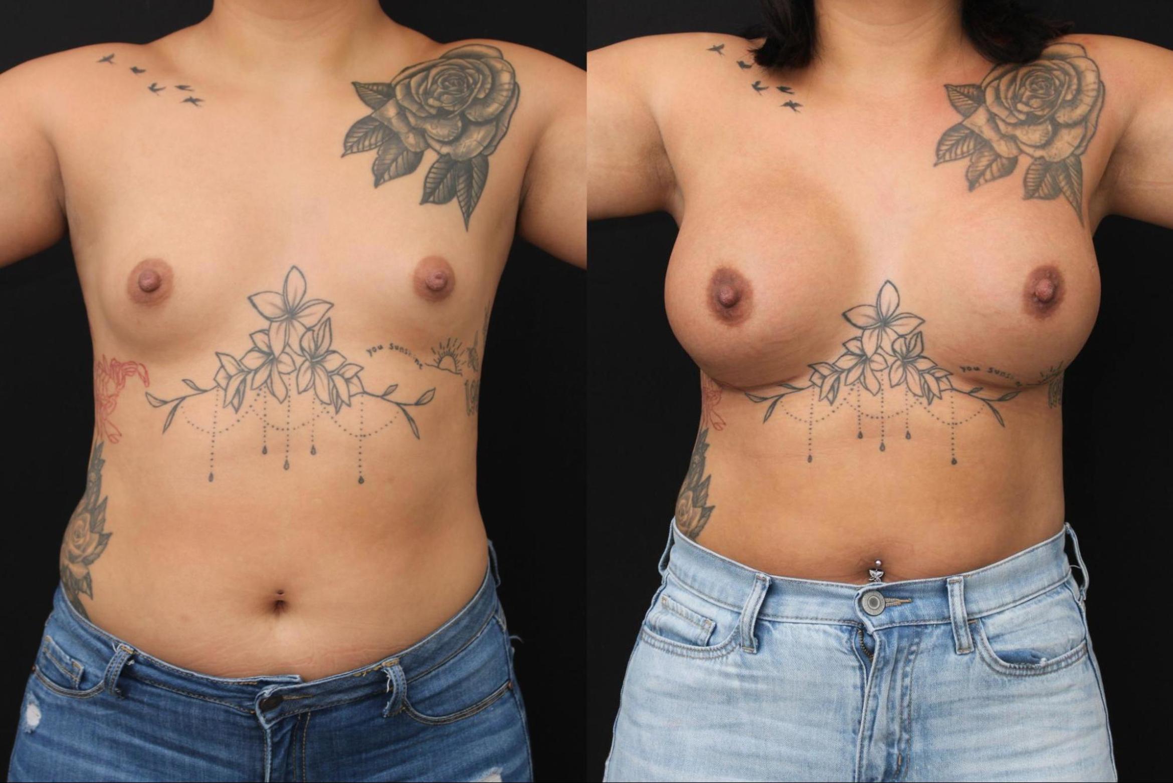 Before & After Breast Augmentation Case 379 View 1 View in Santa Rosa, California