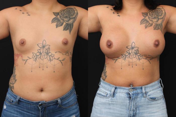 Before & After Breast Augmentation Case 379 View 1 View in Santa Rosa, California