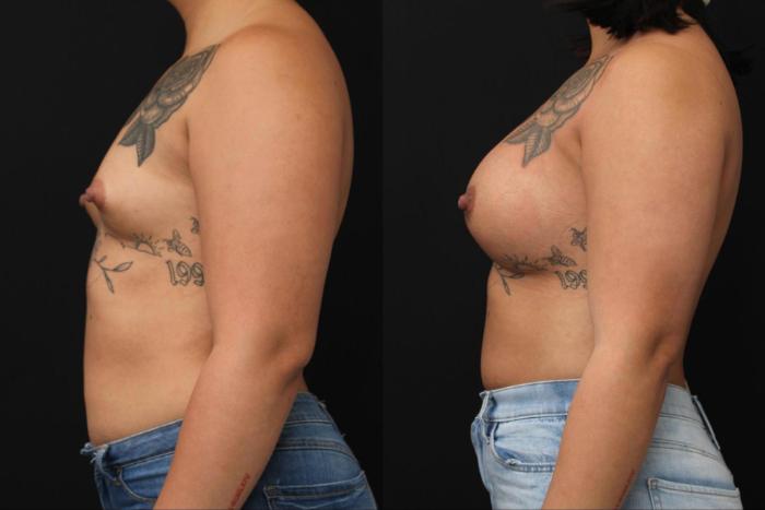Before & After Breast Augmentation Case 379 View 2 View in Santa Rosa, California