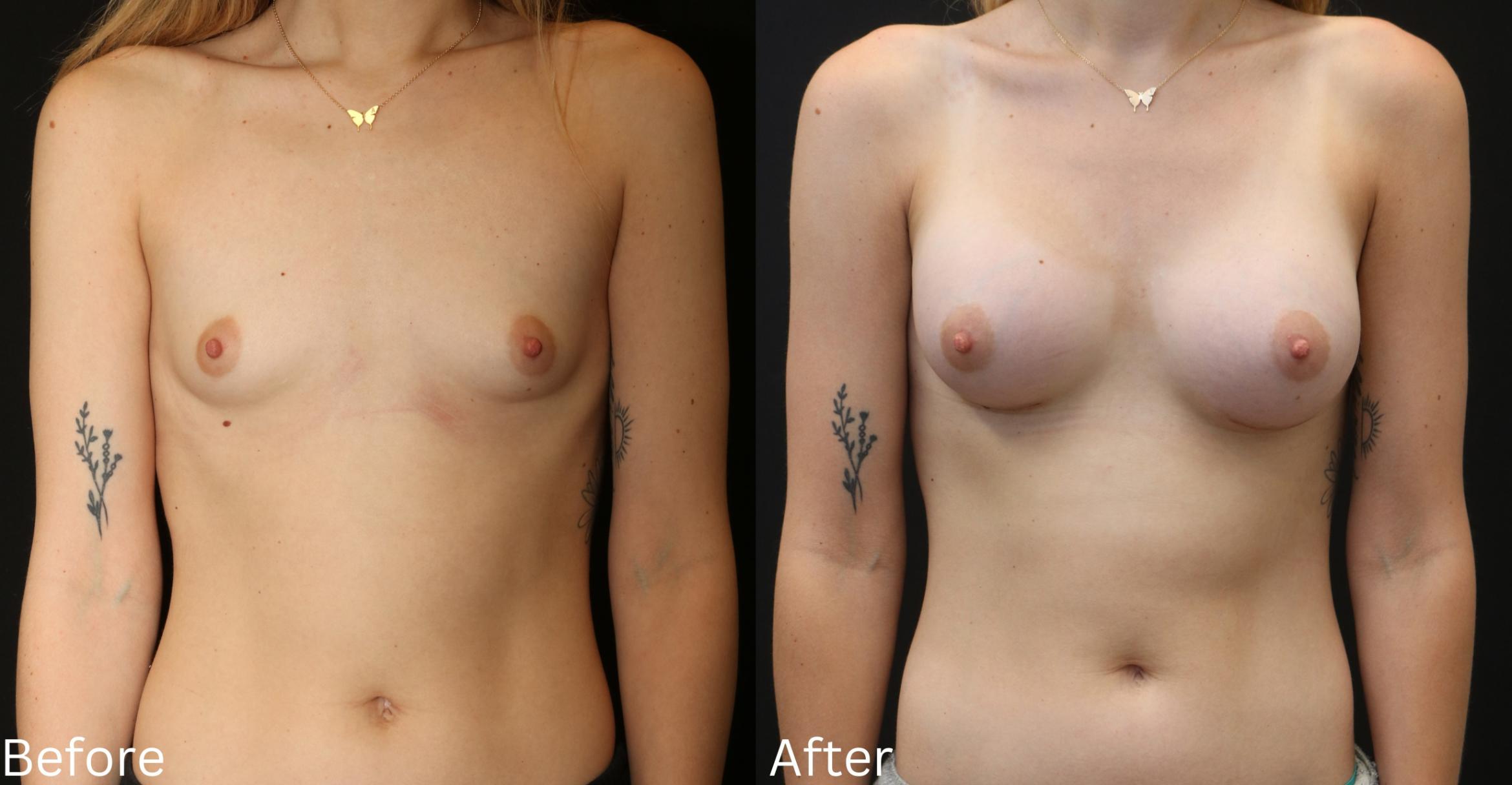Before & After Breast Augmentation Case 95 View 1 View in Santa Rosa, California
