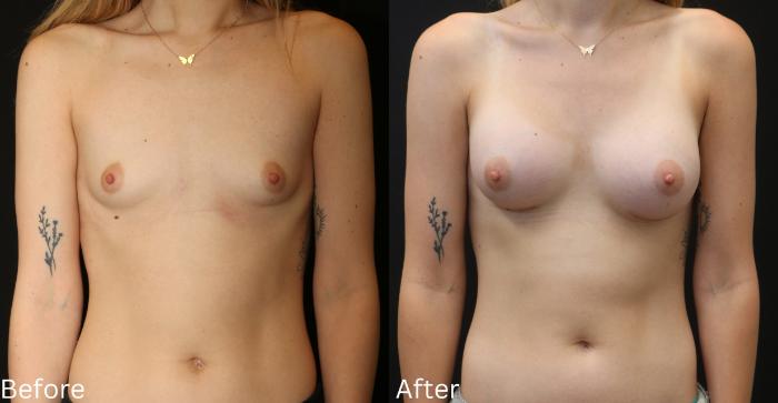 Before & After Breast Augmentation Case 95 View 1 View in Santa Rosa, California