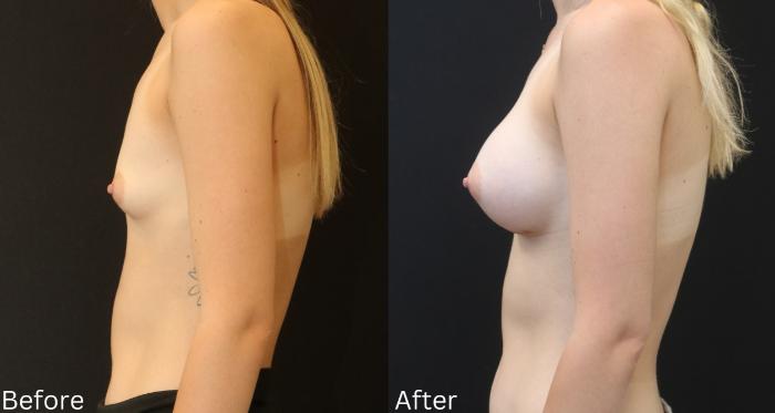 Before & After Breast Augmentation Case 95 View 2 View in Santa Rosa, California