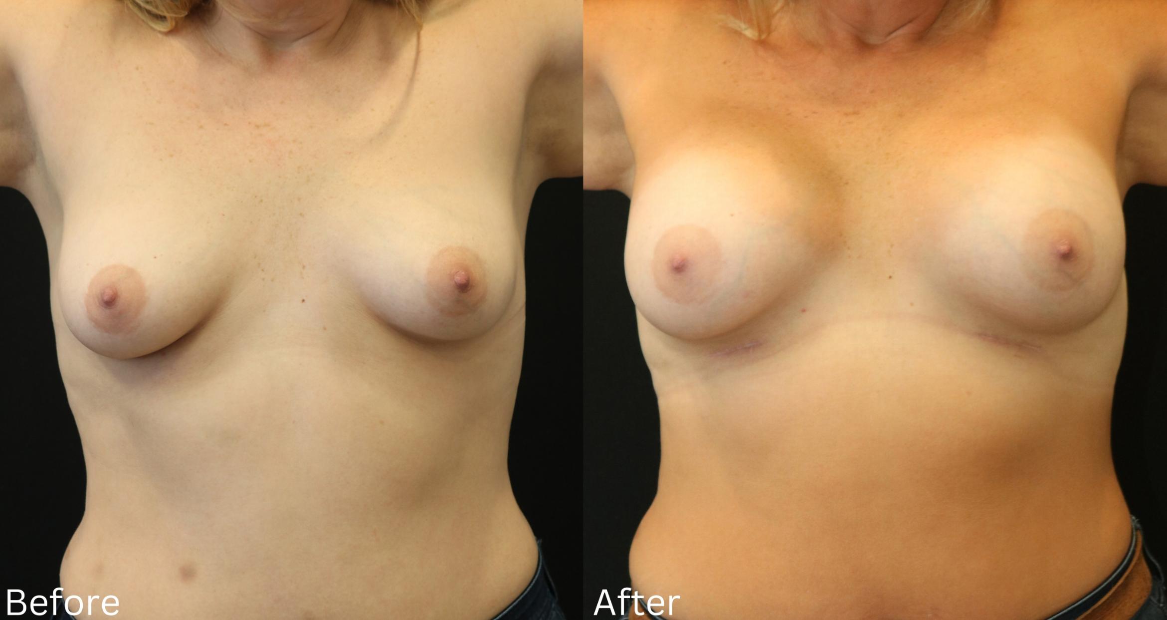 Before & After Breast Augmentation Case 96 View 1 View in Santa Rosa, California